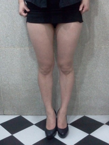 Thigh mini Liposuction | Korea | Before