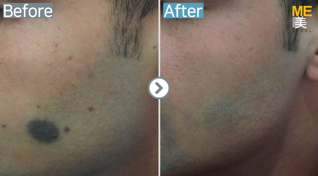 Mole removal - ME CLINIC SEOUL