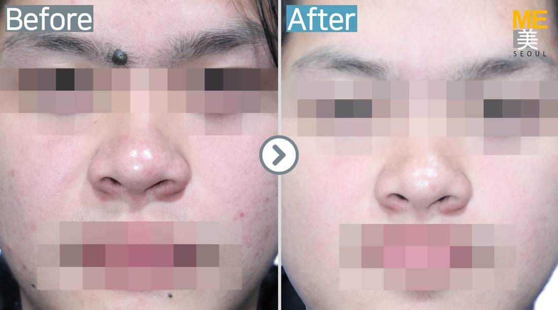 Mole removal - ME CLINIC SEOUL