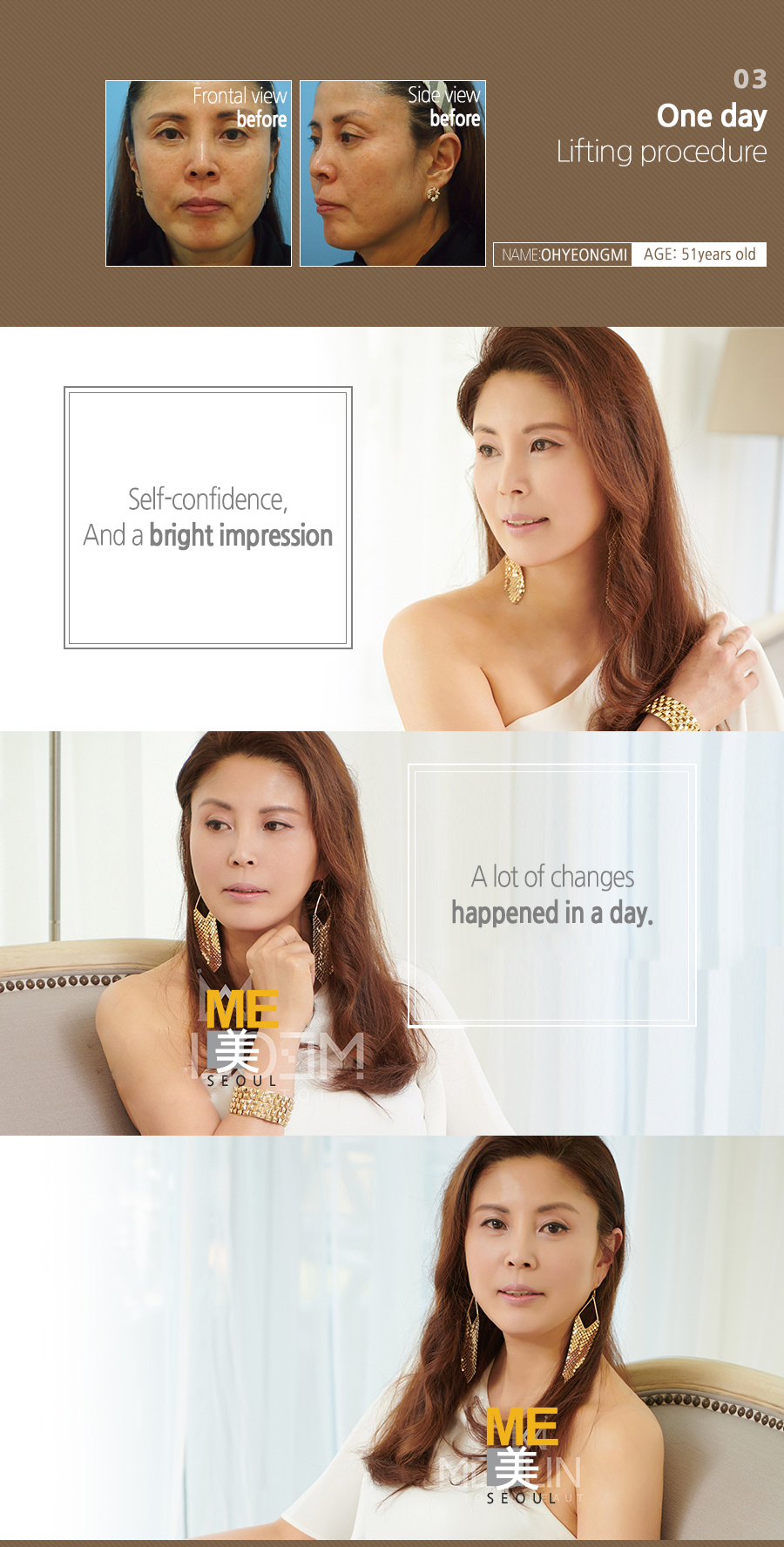 04 One day Lifting procedure